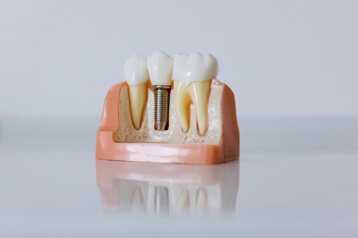 dental implants